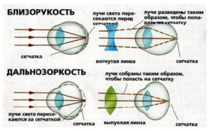 При близорукости изображение фокусируется позади сетчатки